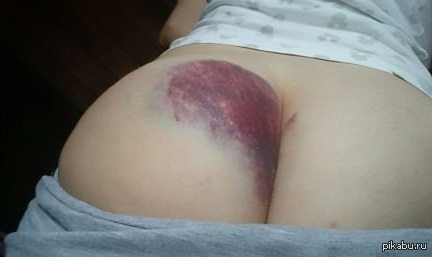 Snowboard? Pffff, falling down the stairs. - NSFW, The fall, Butthurt, Booty, Bruise, Blue