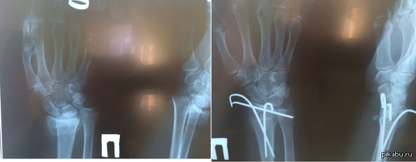 Травматологи заценят.