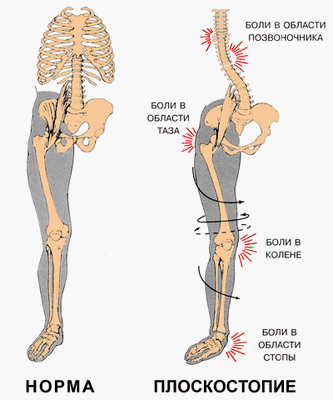 Curiosities about scoliosis - My, Scoliosis, Health, The medicine, Osteopathy, Longpost