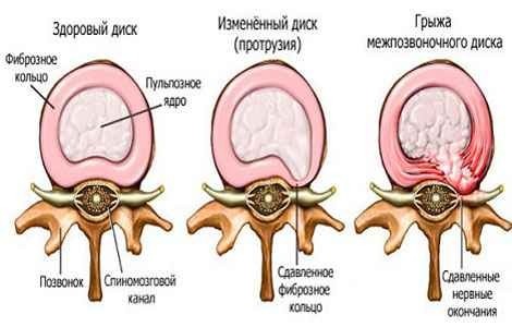 Curiosities about scoliosis - My, Scoliosis, Health, The medicine, Osteopathy, Longpost