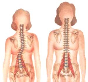 Curiosities about scoliosis - My, Scoliosis, Health, The medicine, Osteopathy, Longpost