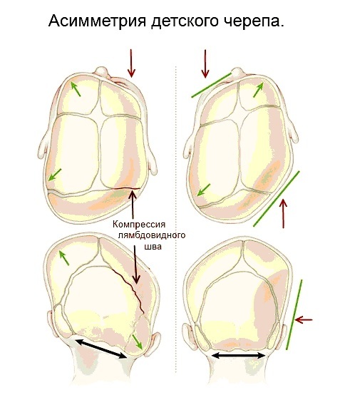 Curiosities about scoliosis - My, Scoliosis, Health, The medicine, Osteopathy, Longpost