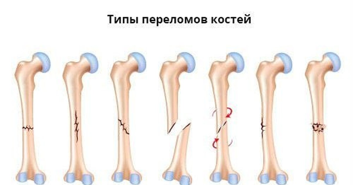 Поставить на 4 кости. Перелома кости: по виду смещения отломков. Типы переломов трубчатых костей.