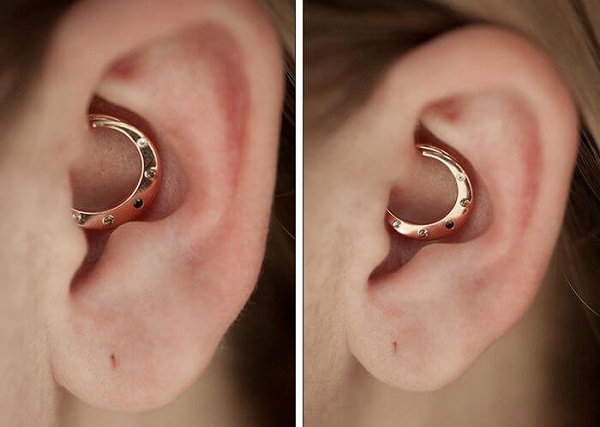 Дейс пирсинг (Daith piercing) - Пирсинг, Пирсинг уха, Дейс пирсинг, Лигалюбителейпирсинга, Длиннопост