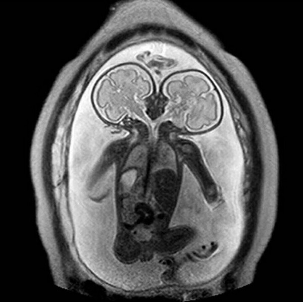 МРТ двухголового человека
