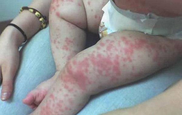 Rospotrebnadzor received 832 appeals from those infected with the Coxsackie virus - Children, Turkey, Russians, Health, Virus, , Rospotrebnadzor, TASS, Coxsackie viruses