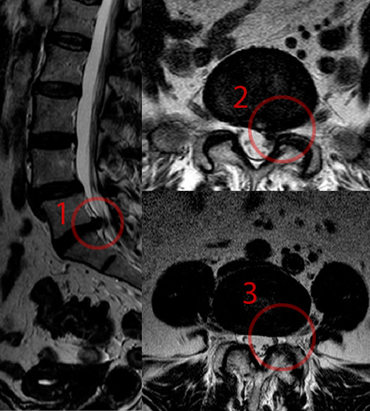 Intervertebral hernia almost visually - Intervertebral hernia, Neurosurgery, MRI