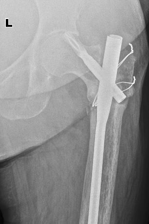 From the life of a radiologist. Part 1. - My, Radiology, Sos, Osteosynthesis, Longpost, The medicine