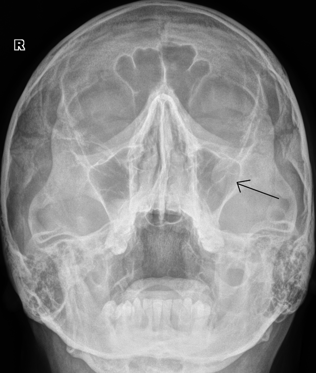 Как выглядит фронтит. Рентген пазух носа фронтит. Острый фронтит рентген. Двухсторонний верхнечелюстной синусит рентген. Фронтит снимок рентген.