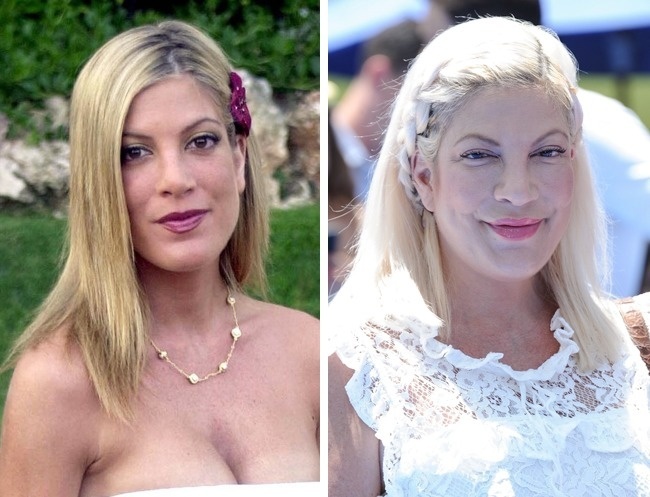 What celebrities looked like before plastic surgery - ADME, Plastic surgery, Celebrities, Longpost