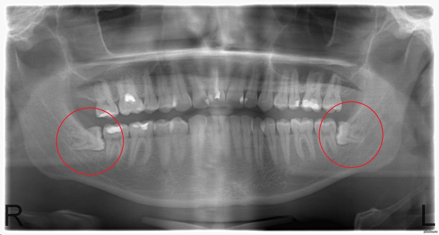 Дистопированный зуб мудрости рентген