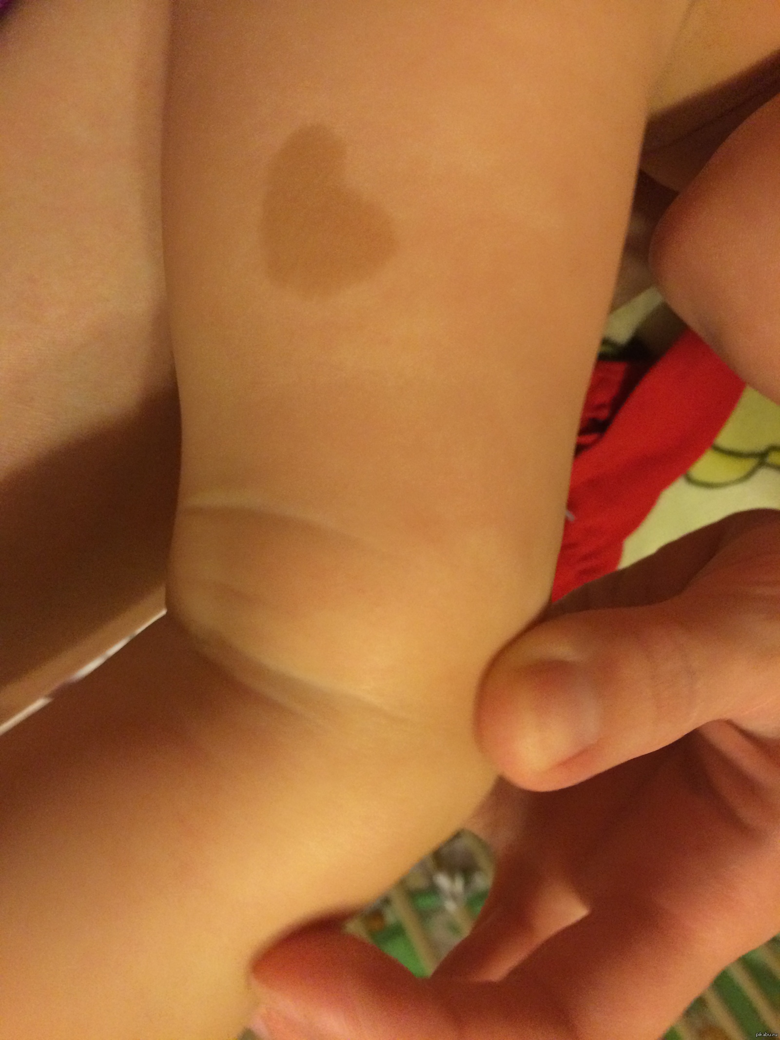 Родимое пятно на ноге у ребенка