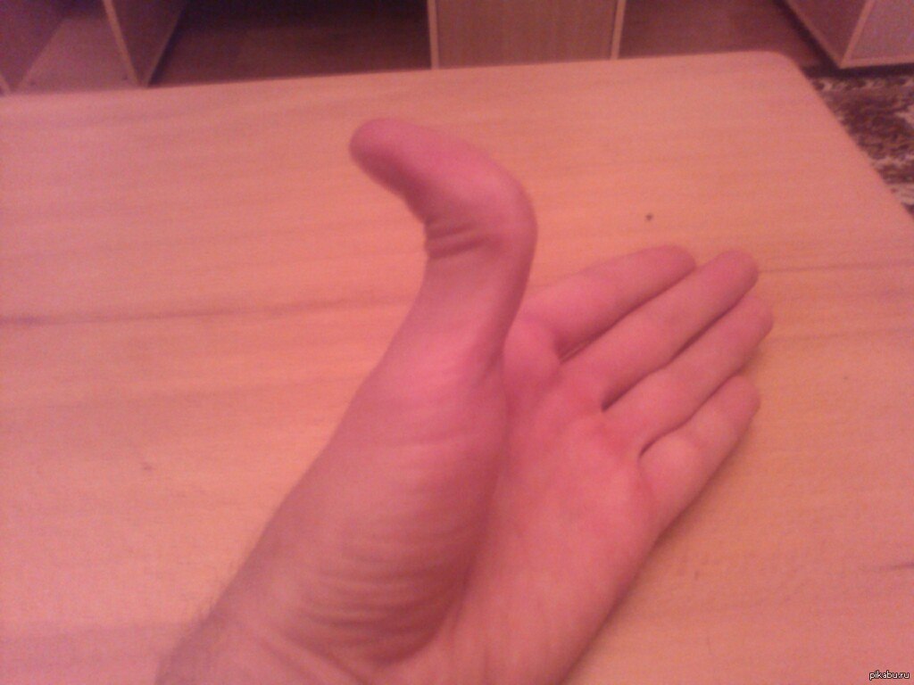 Согнулась фаланга пальца. Утром плохо сгибаются пальцы. Утром плохо сгибаются пальцы. Утром плохо сгибаются пальцы. Утром плохо сгибаются пальцы.