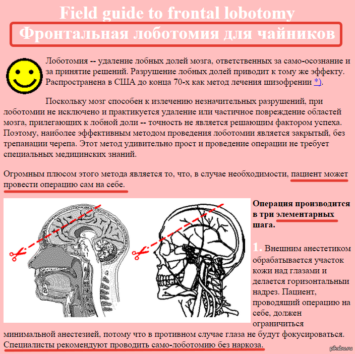 Что такое лоботомия. Префронтальная Лоботомия. Трансорбитальная Лоботомия.