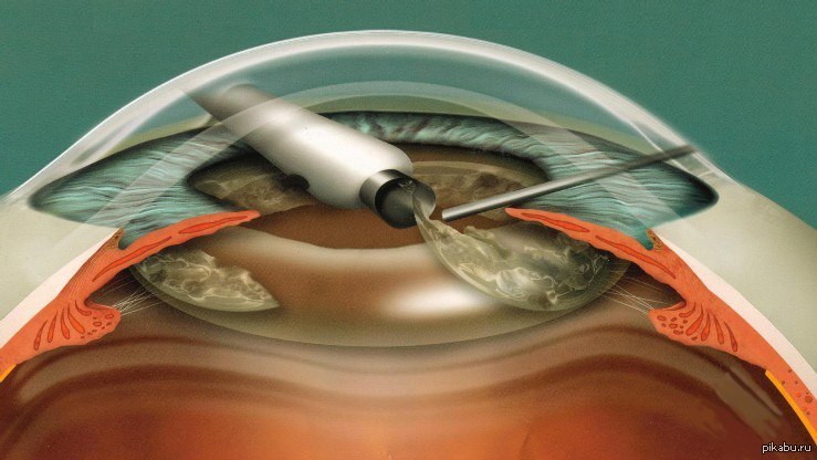 Операция катаракта по полису