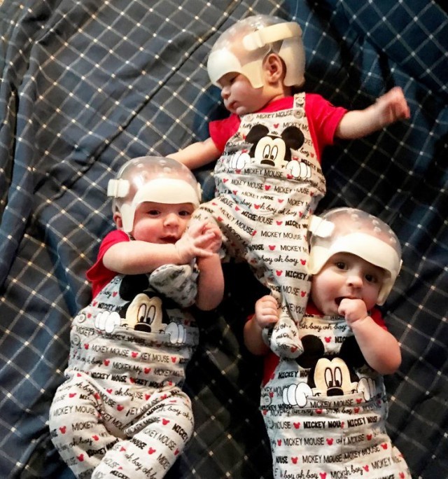 One in 500 trillion chance: why are these triplets wearing special helmets? - Children, Parents, Chance, Help, Health, Triplets, Helmet, Disease, Longpost