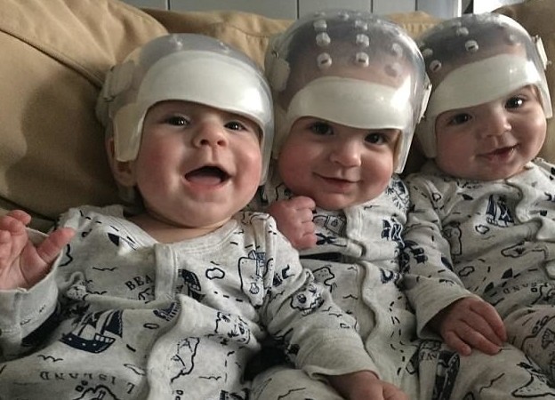 One in 500 trillion chance: why are these triplets wearing special helmets? - Children, Parents, Chance, Help, Health, Triplets, Helmet, Disease, Longpost