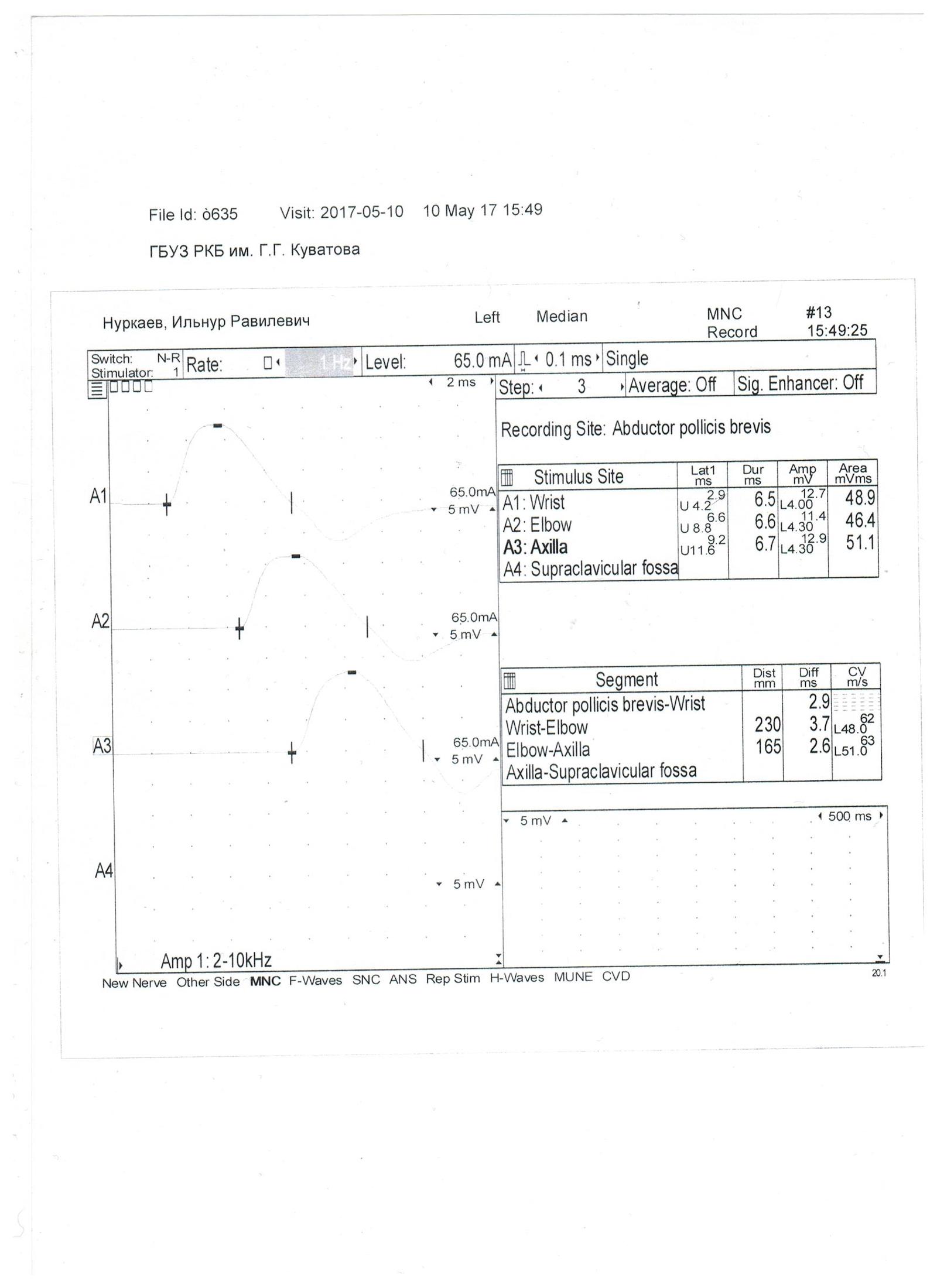 Undertook to study the direction of electroneuromyography and need help with decoding - My, , , Neurology, Neurosurgery, The medicine, Longpost