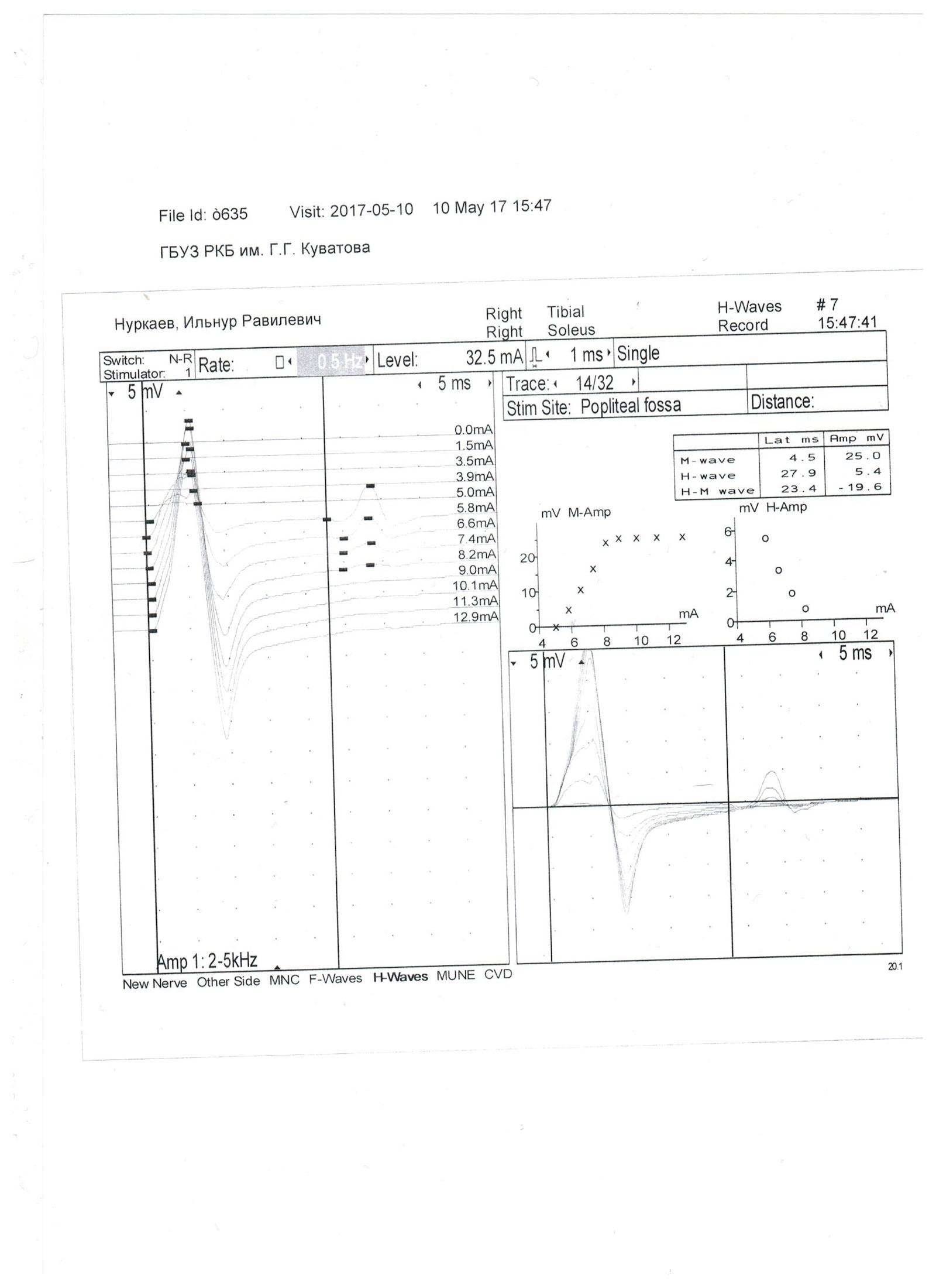 Undertook to study the direction of electroneuromyography and need help with decoding - My, , , Neurology, Neurosurgery, The medicine, Longpost