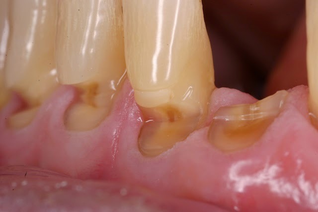 Affordable Dentistry #6: Eights \ Wedge Defect \ Braces \ Periodontitis - Longpost, My, Dentistry, Health, beauty, The medicine, Teeth