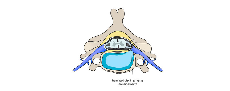 A little about the health of the spine and proper posture - My, Fitness, Exercises, Posture, Back, Spine, , Hernia, Longpost