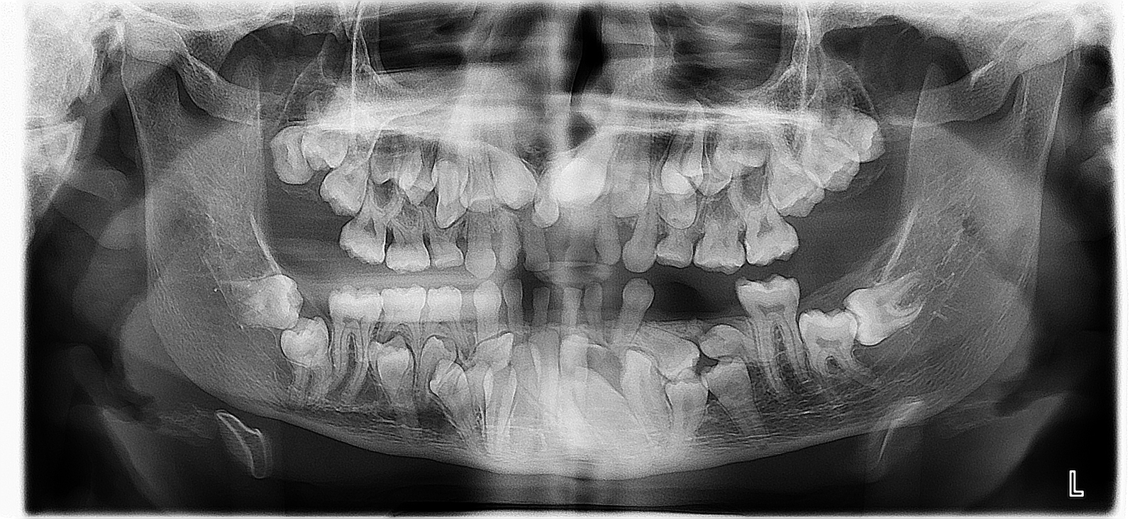 рентгеновский снимок зуба фото