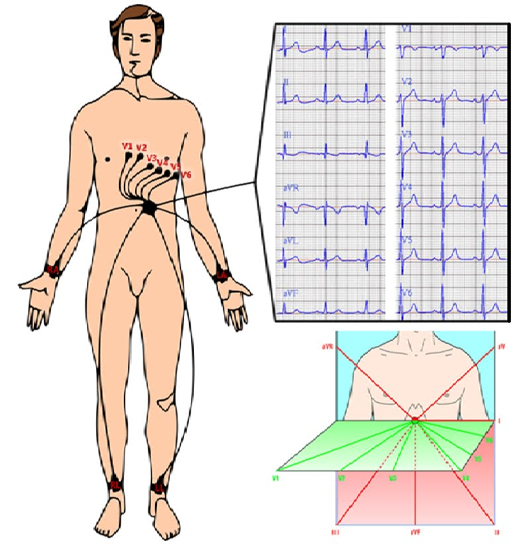 What does the ECG hide? - ECG, The medicine, Cardiology, Heart, Longpost