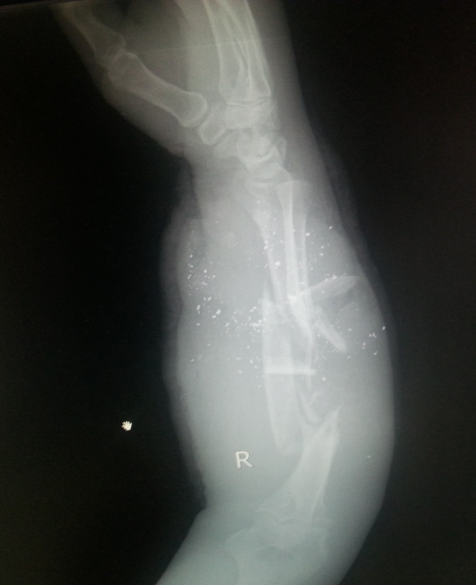 Fuck what a comminuted fracture of the bones of the forearm - Traumatology, The medicine, Fracture, Breaking, Longpost, Radiology