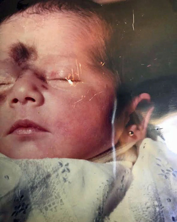 Mariana Mendez was born with a mole covering the central area of ??her face - Nevus, , Longpost, Birthmarks