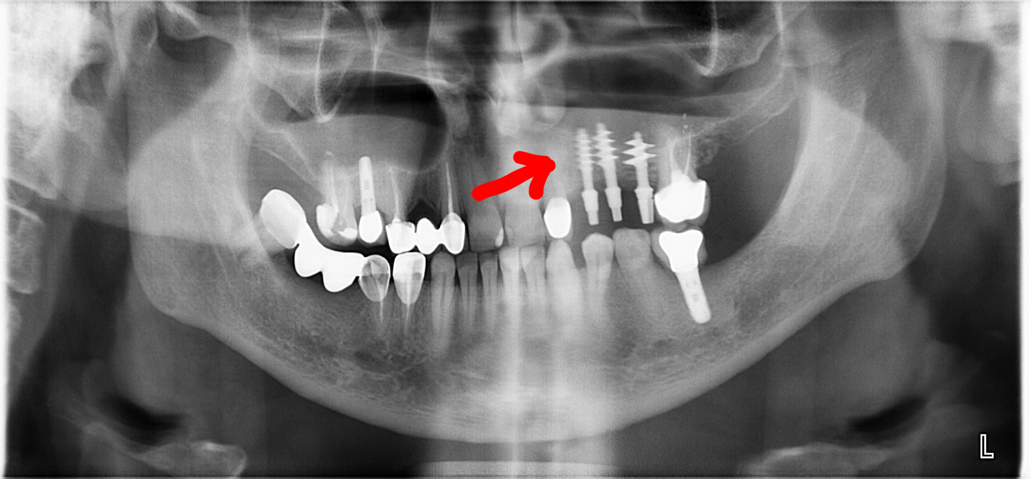 Basal implantation or ALDP* - My, Dentistry, Implantation, Teeth, Longpost